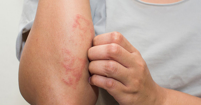 Bệnh chàm hay còn gọi là viêm da dị ứng thực chất là một bệnh viêm và rối loạn mãn tính của da do thiếu kẽm